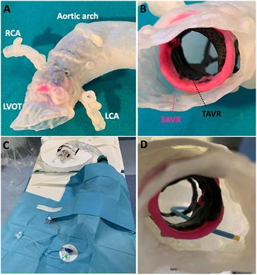 Coronary access following ACURATE neo implantation for transcatheter aortic valve-in-valve implantation: Ex vivo analysis in patient-specific anatomies